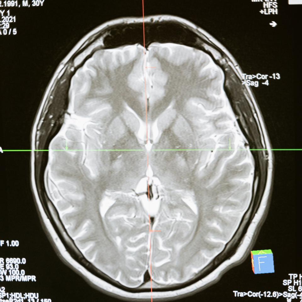 Brain scan