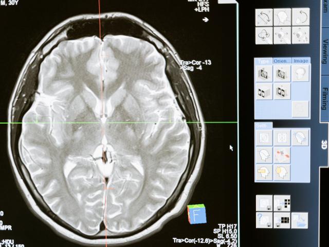 Brain scan